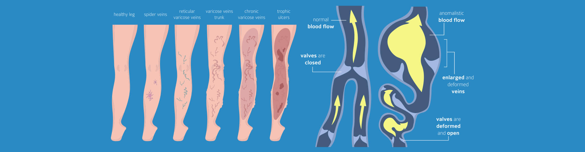 leg-pain-caused-by-varicose-veins-texas-cardiologist-near-me