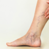 Varicose Veins and Chronic Venous Insufficiency