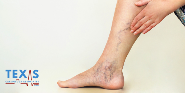 Varicose Veins and Chronic Venous Insufficiency