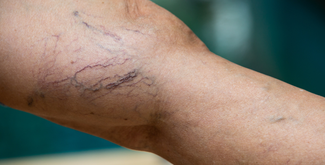 Veins in patient arm visible