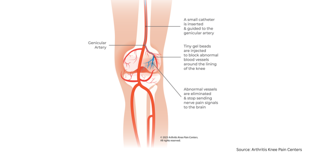 visual of the knee and medical gae